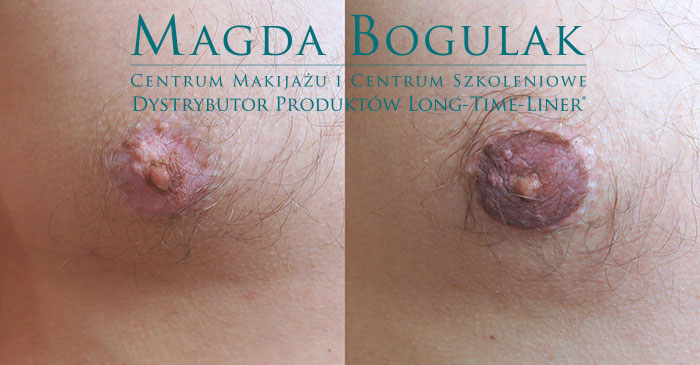 plamy bielacze na piersiach